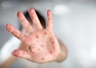 CDC: Cacar Monyet Tak Akan Minggat dalam Waktu Dekat
