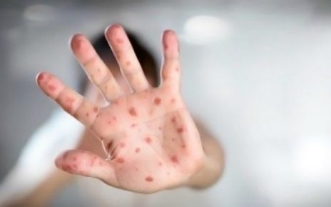 CDC: Cacar Monyet Tak Akan Minggat dalam Waktu Dekat