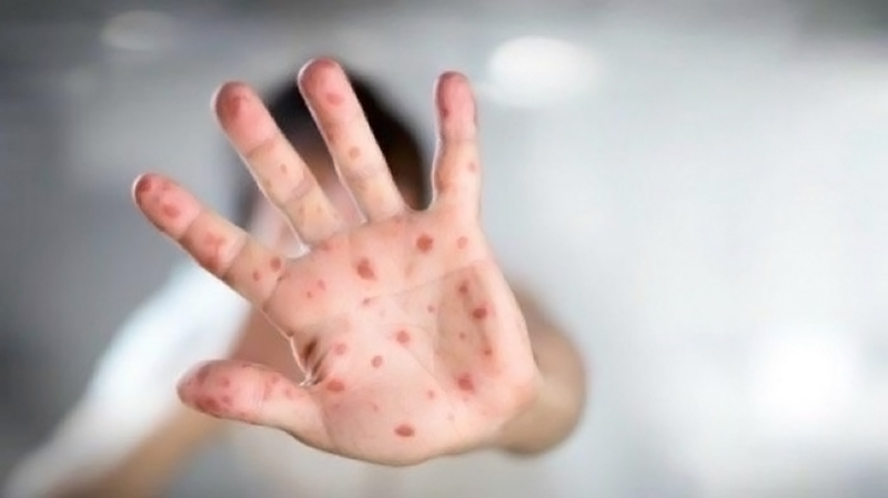 CDC: Cacar Monyet Tak Akan Minggat dalam Waktu Dekat
