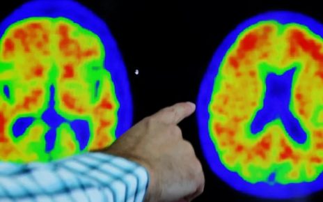 Peneliti Temukan Terobosan Baru Dalam Obati Alzheimer