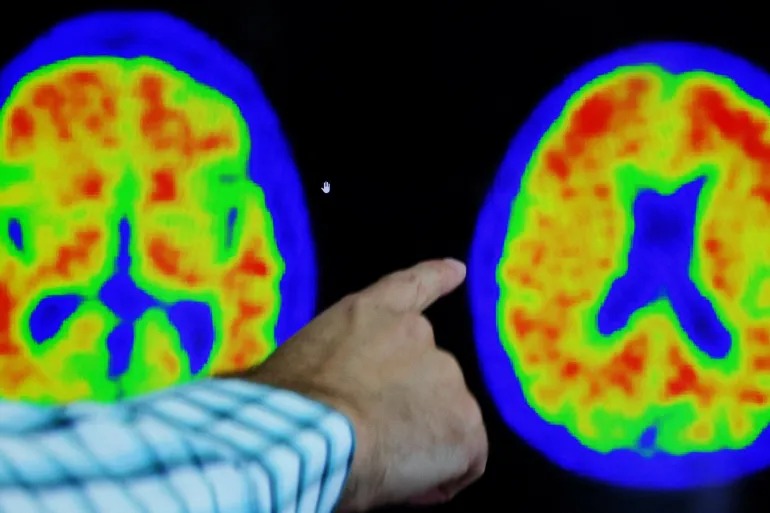 Peneliti Temukan Terobosan Baru Dalam Obati Alzheimer